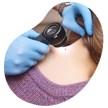 Tratamiento de crioterapia