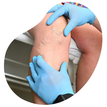 Consulta de angiología