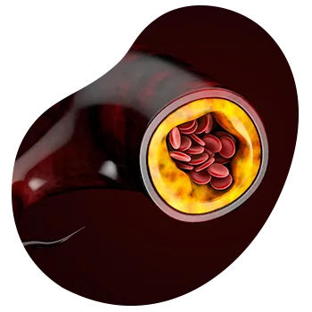 Ecografía Doppler Arterial